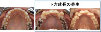 前歯の叢生