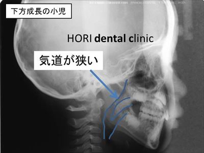 気道が狭い小児のレントゲン